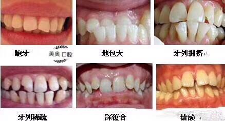 69 牙套完成 69【牙分享#牙齿矫正#x 牙齿畸形的危害很大哦