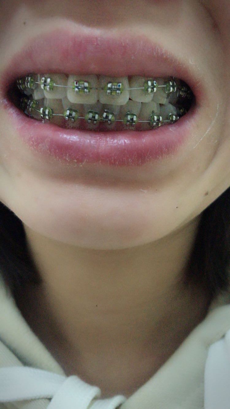 牙齿有些前凸,没有拔牙,戴上牙套9天,牙齿咬合不对了
