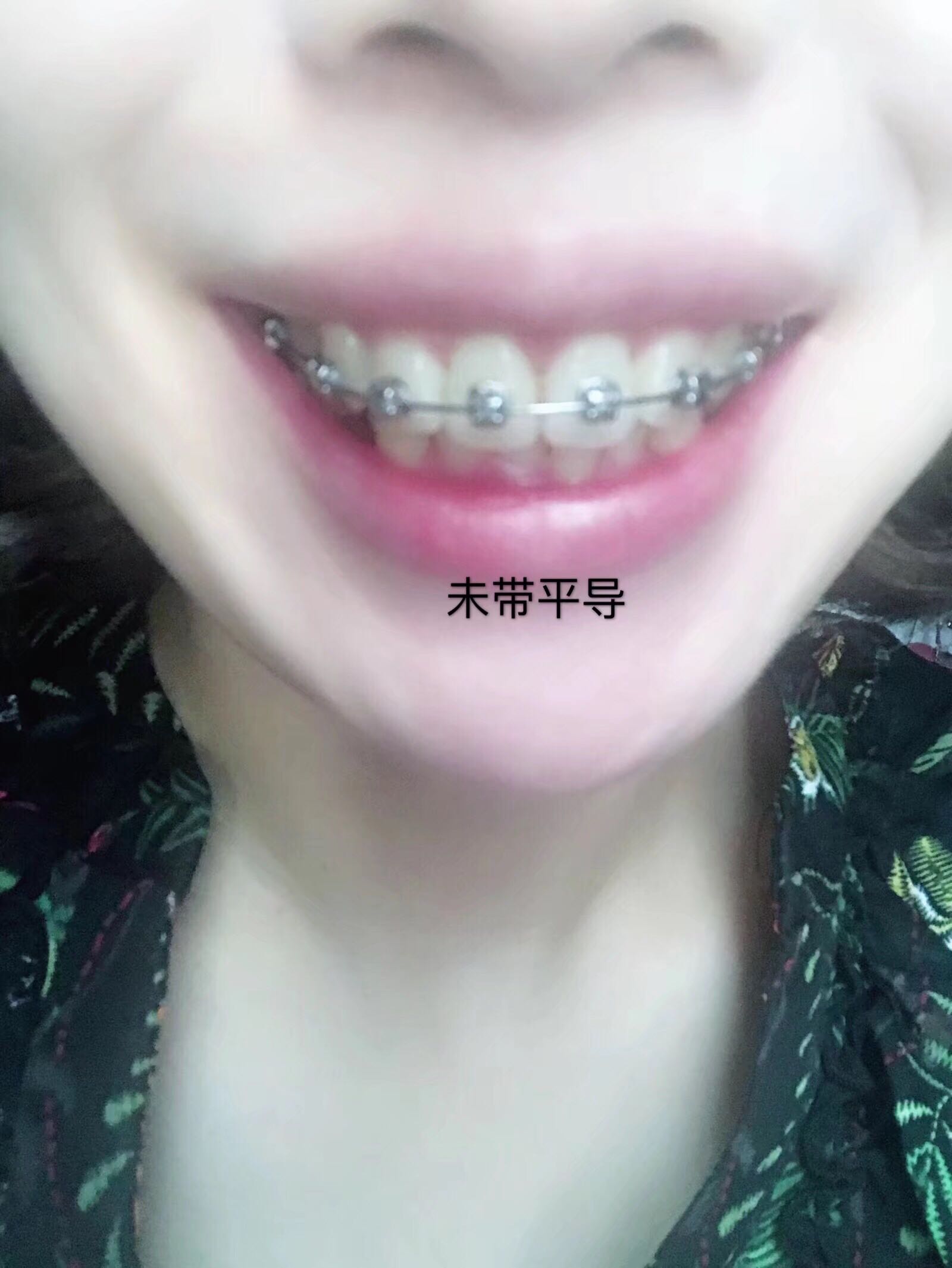 平导ing,效果还是明显 - 牙套日记 - 牙齿矫正人气-之