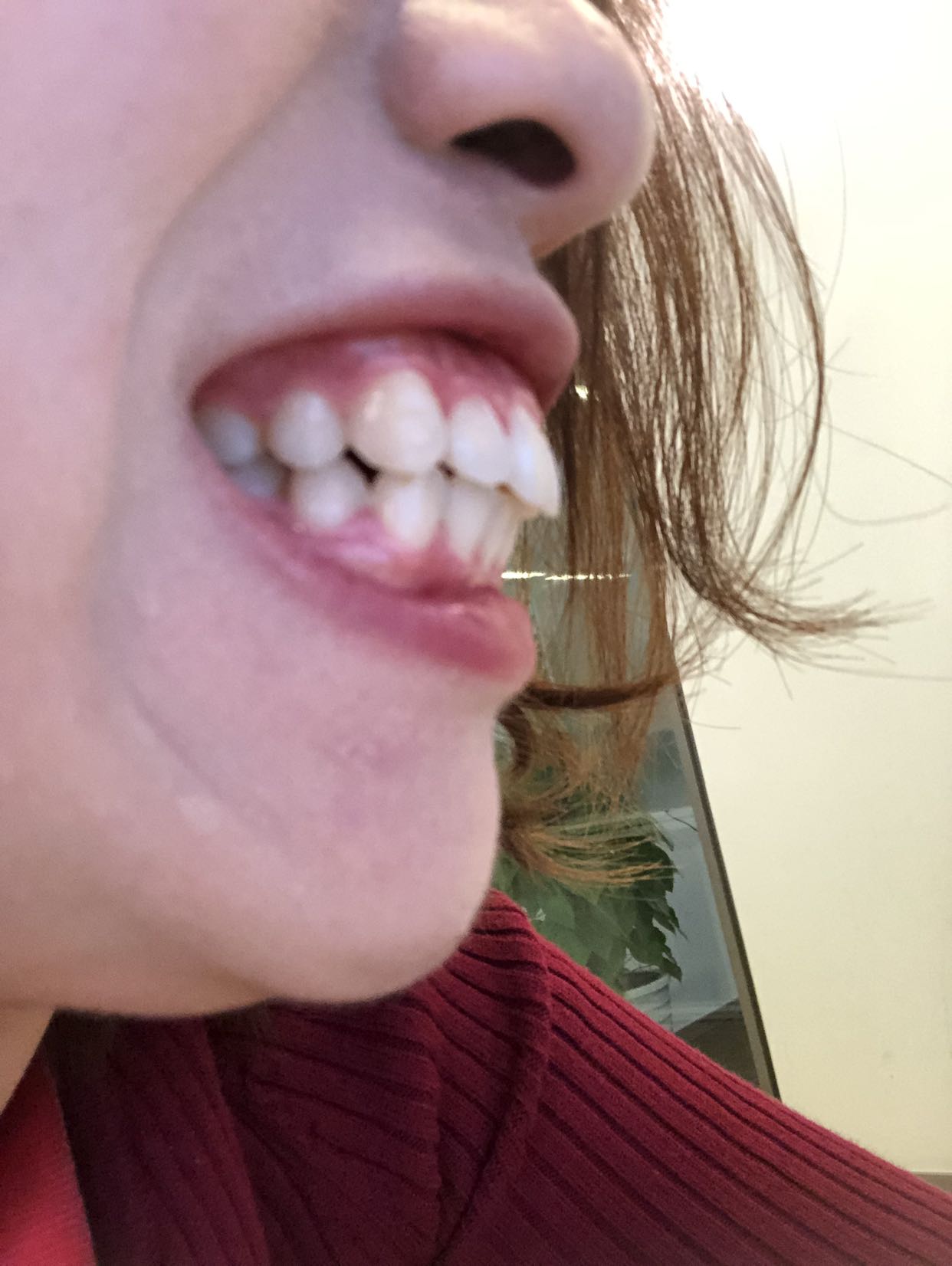 骨性龅牙,我这种,箍牙能改善到什么程度?