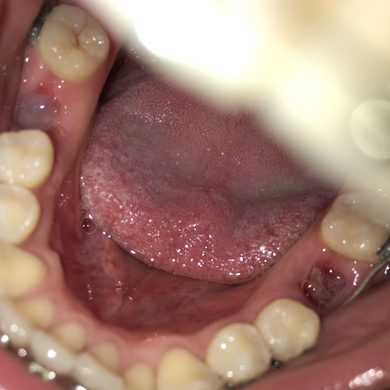 关于拔牙伤口恢复和干曹症