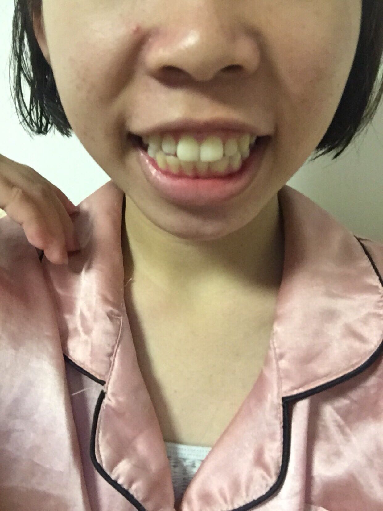 龅牙-牙套前自拍-牙套之家|牙齿矫正 中国最大的牙齿