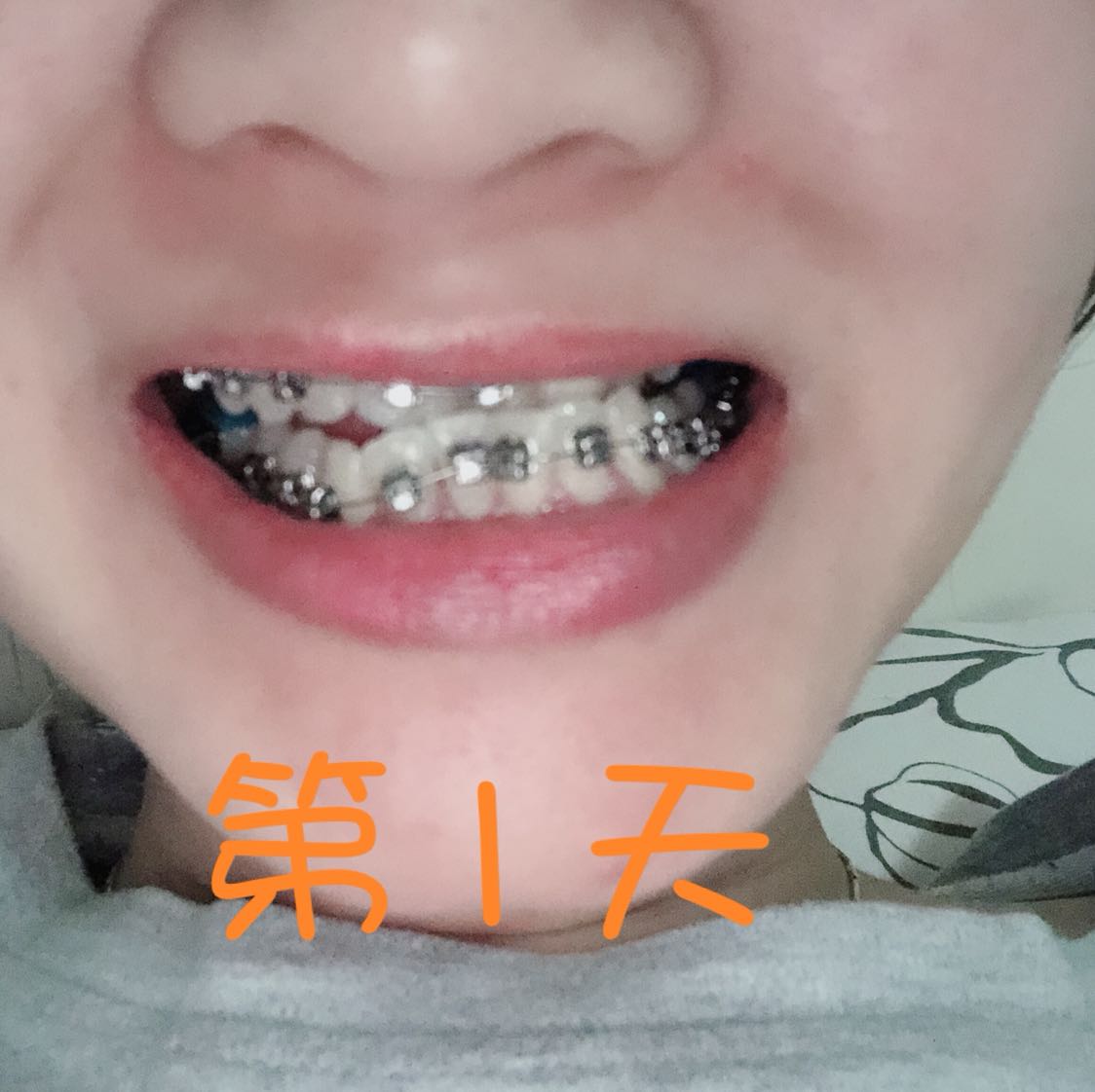 地包天矫正