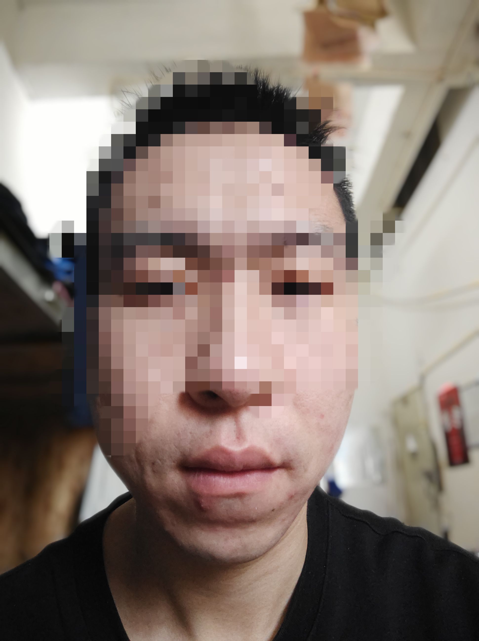 我这是不是牙槽骨突出?