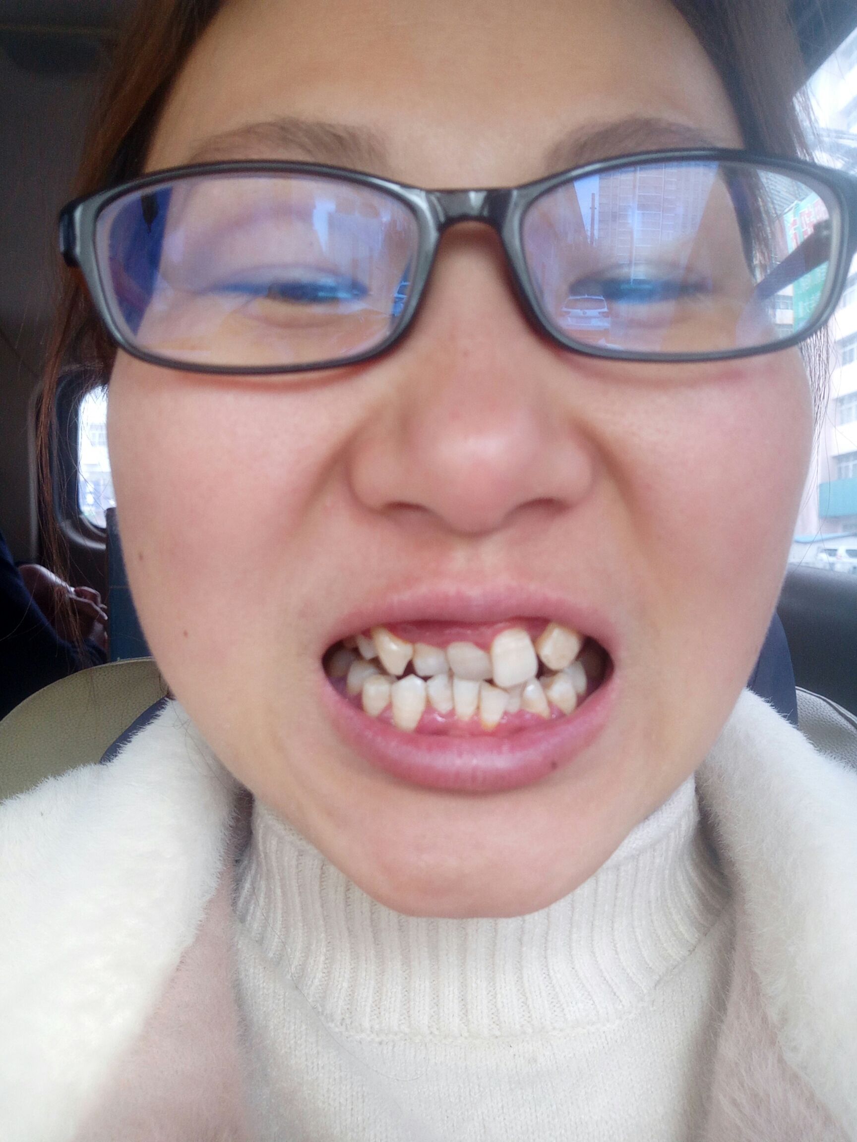 32岁老阿姨,牙齿超级歪扭,准备矫正