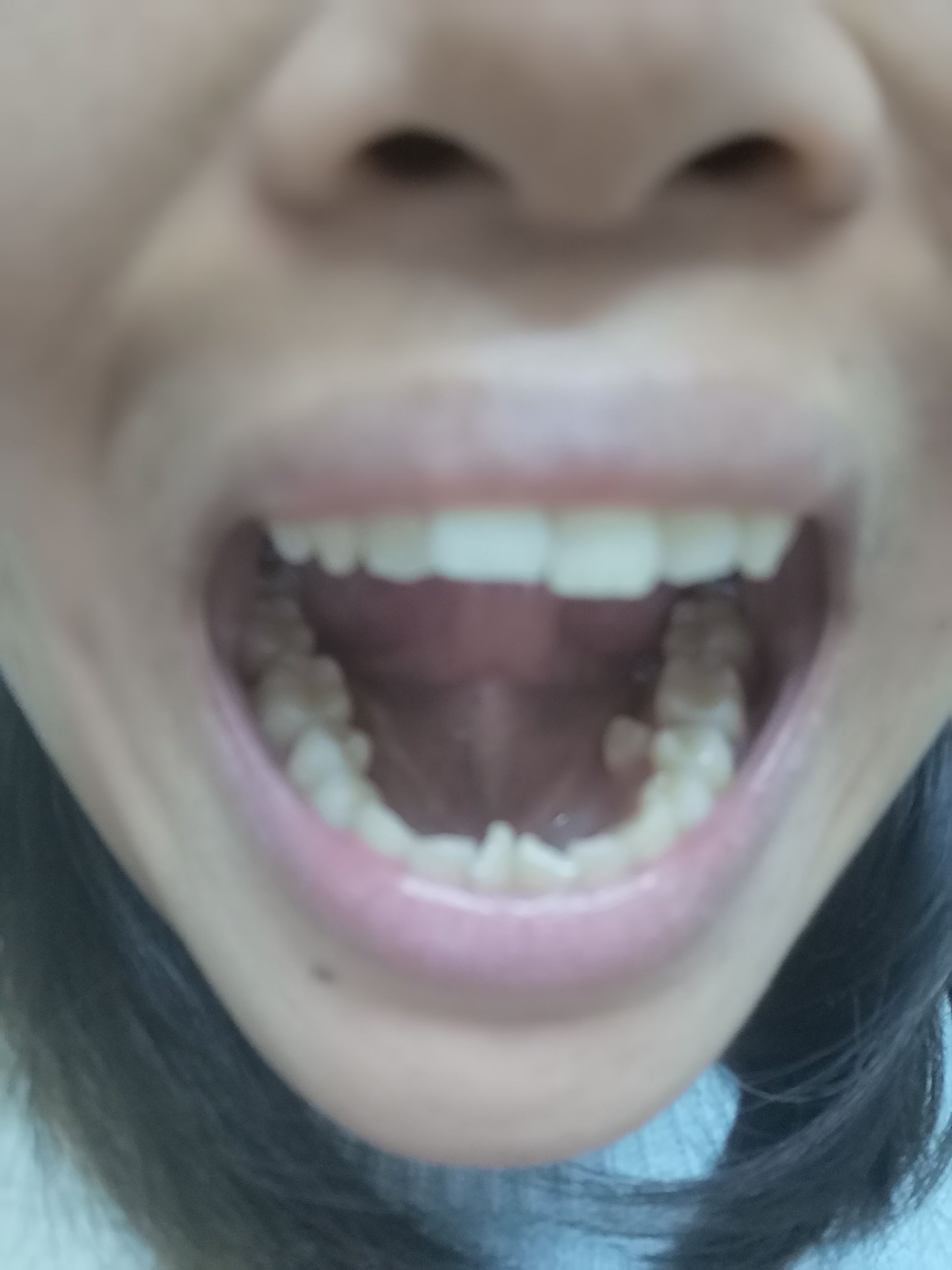 大牙变小牙进行时 - 贝致——专业口腔服务平台，让你变美的牙套交流社区