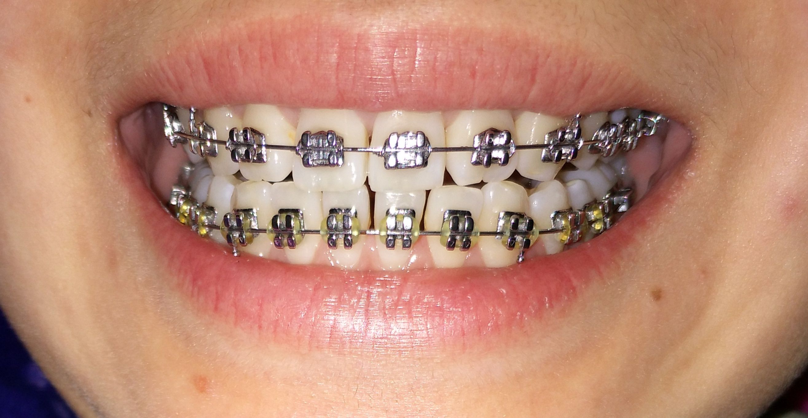 363天-牙套日记-牙套之家|牙齿矫正 中国最大的牙齿矫正论坛及精神