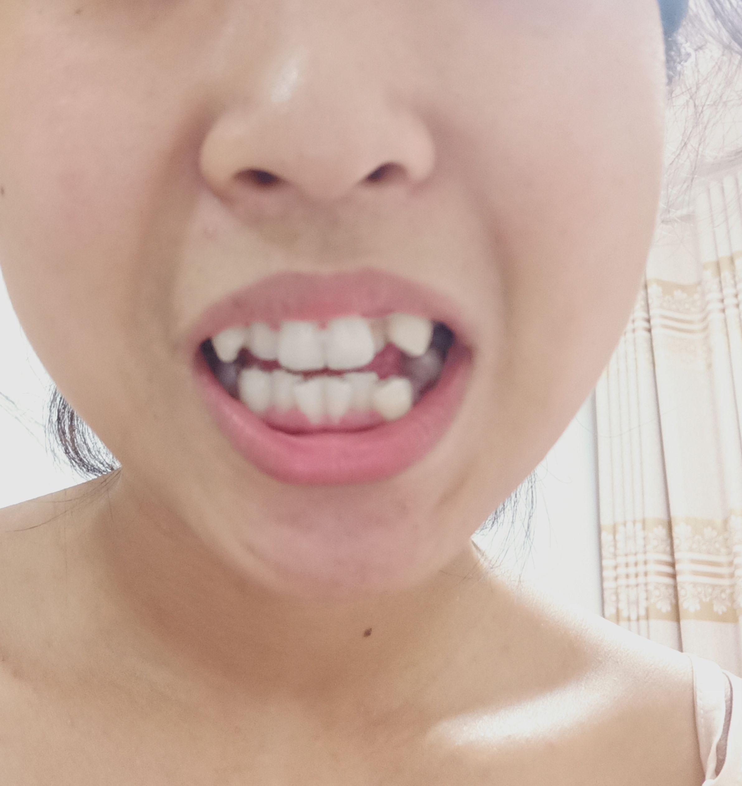 第一副隐形牙套 2019-07-03 21:38:38 油