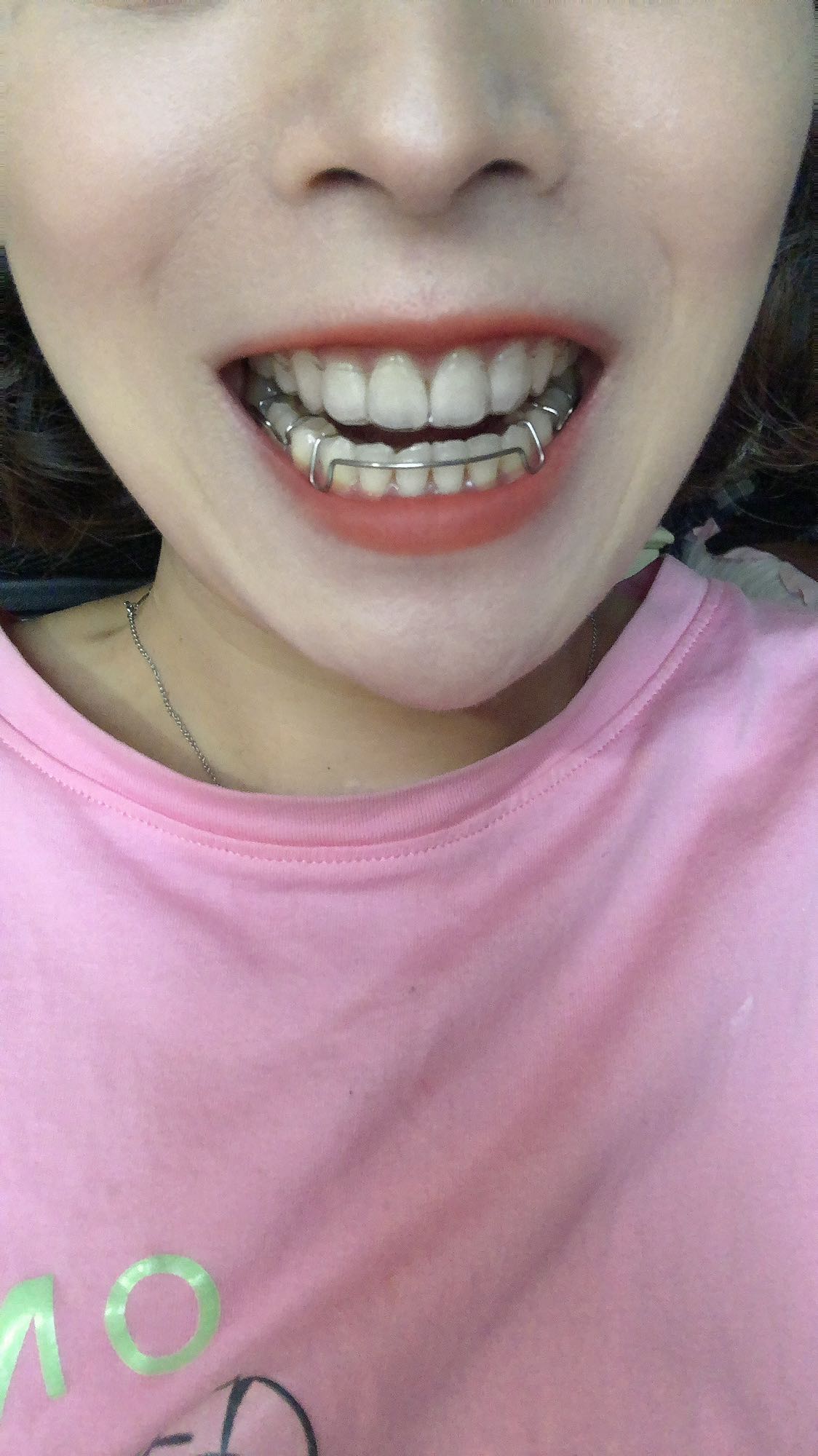 由于透明保持器不能咬合在一起,哈雷保持器说话又大舌头93,现在每天