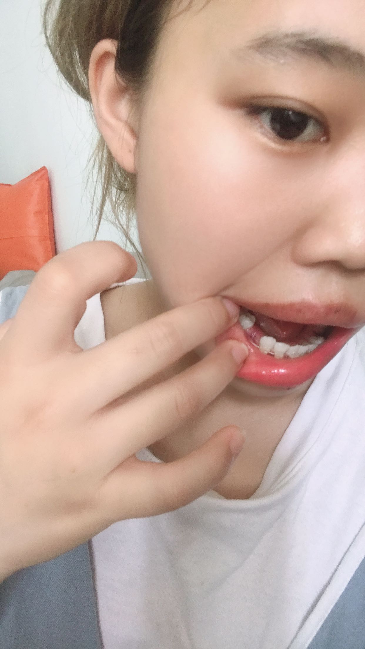 姐妹们你们拔牙的牙洞大吗我咋感觉我这牙洞这么大刚带上牙套20多天