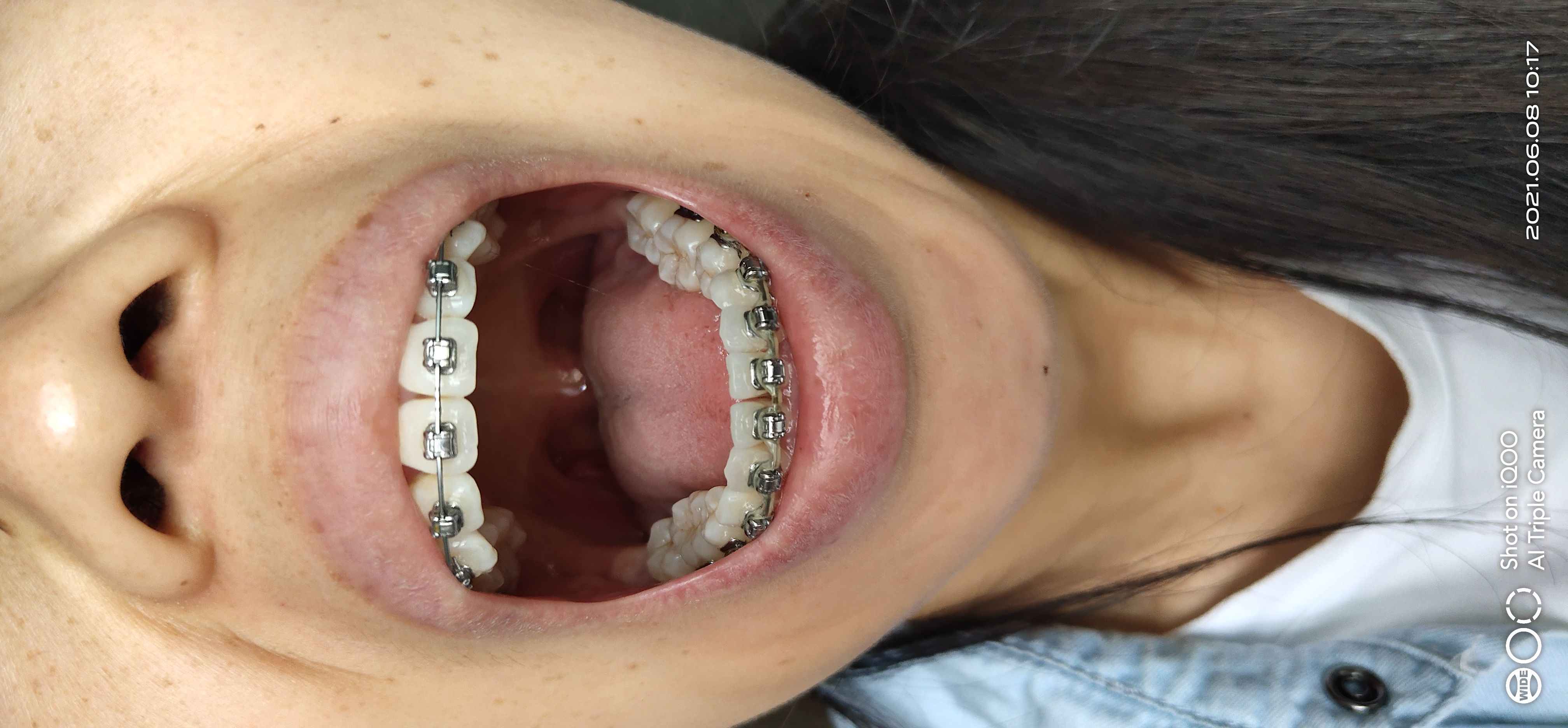 下面拔了2颗4号牙,排齐即收缝!