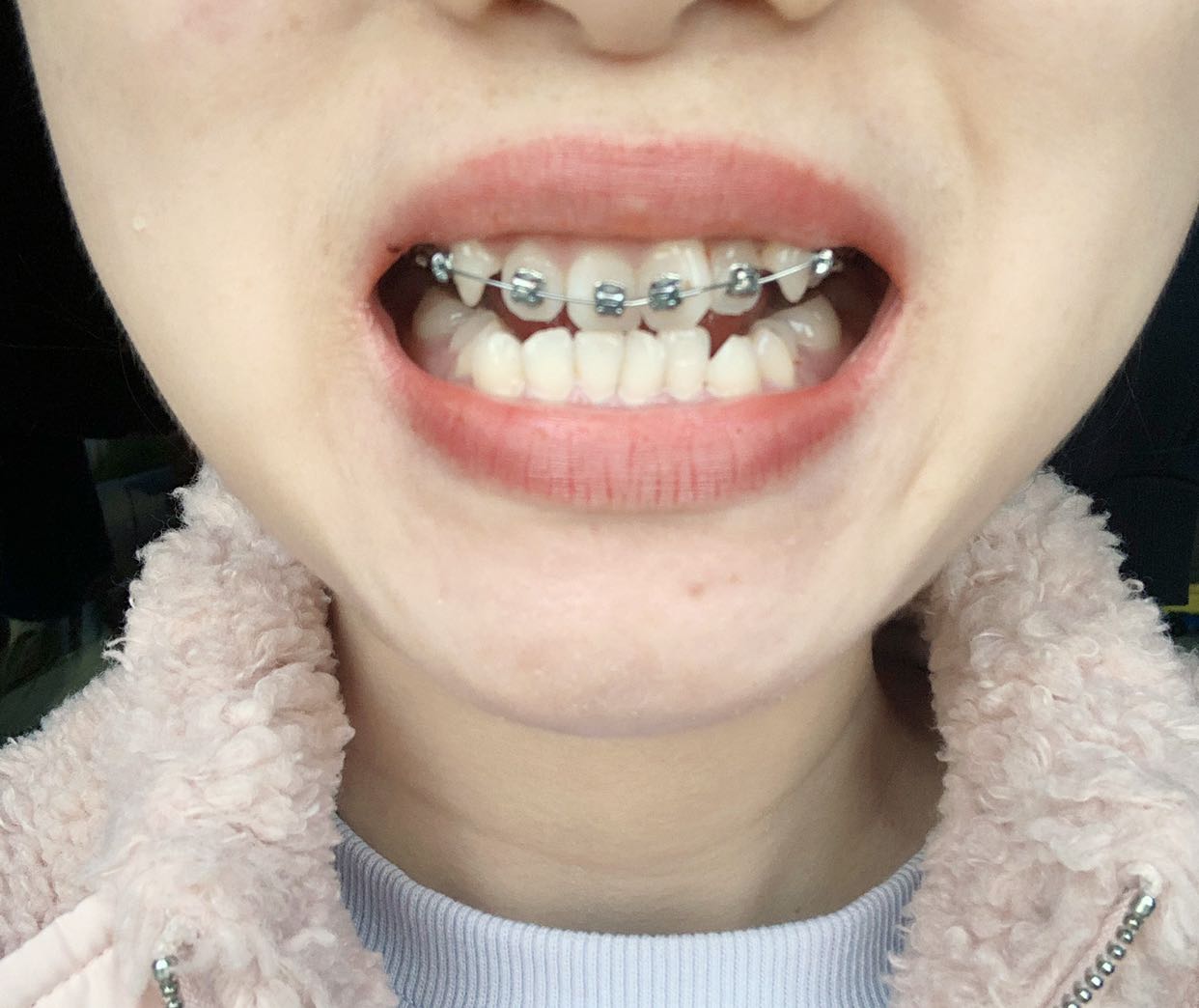 瑶瑶781003这一年确实有变化,感觉尖牙估计. .